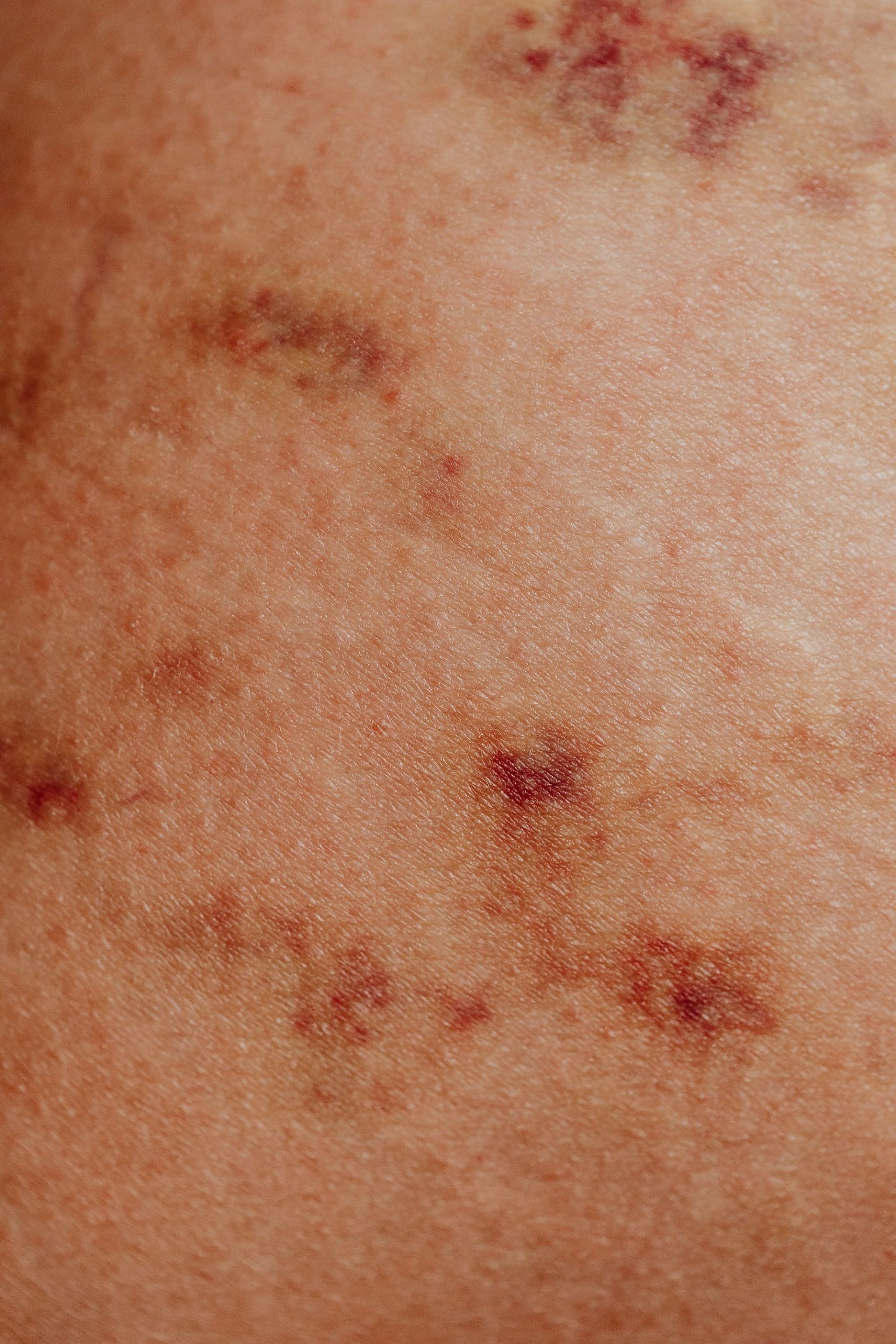 Heat rash looks like red bumps (Image via Pexels/Karolina Grabowska)